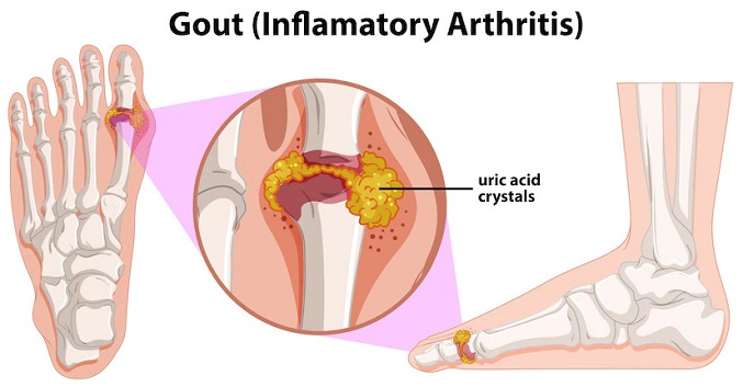 Uric Acid Test  Uric Acid Test Procedure 