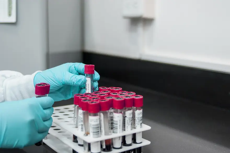 MCV Blood Test and Normal Range