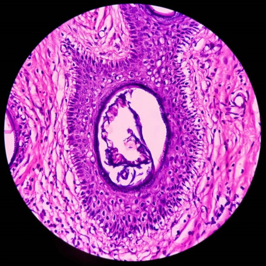 teratoma meaning in hindi