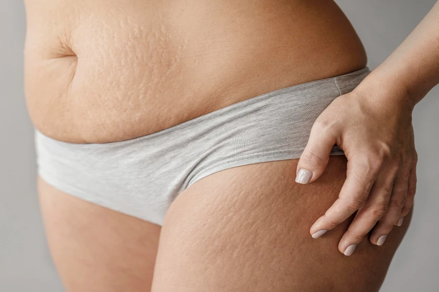 Causes, Symptoms, And Treatments For Stretch Marks