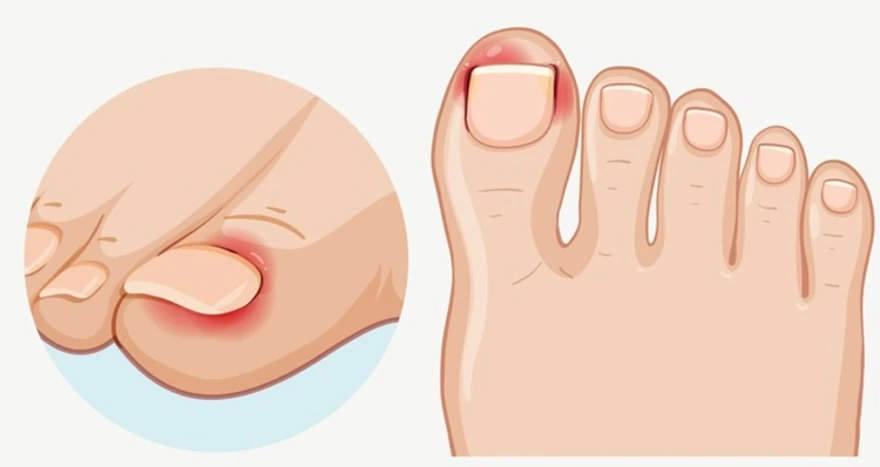 Nail fungus treatment