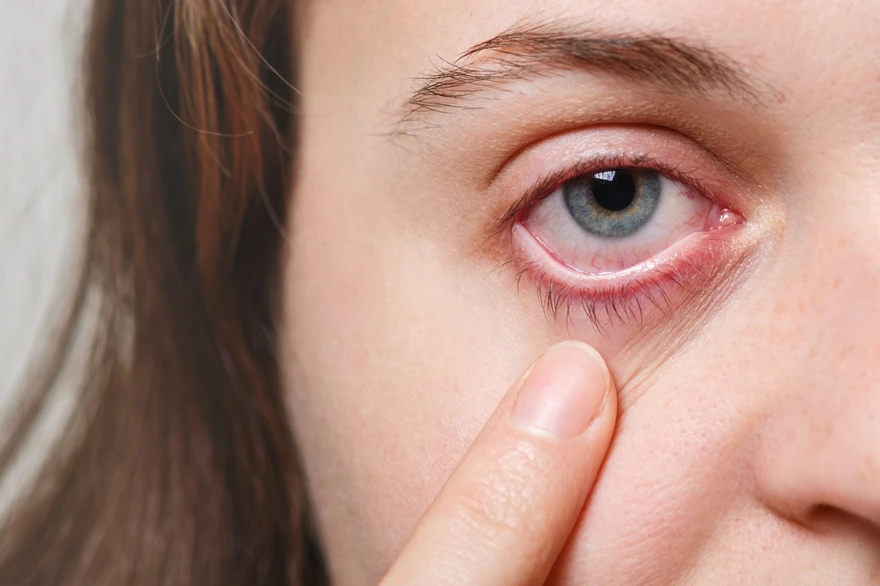 Blepharitis self-care