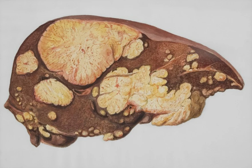 Elevated Liver Enzymes  Causes, Symptoms & What to Do