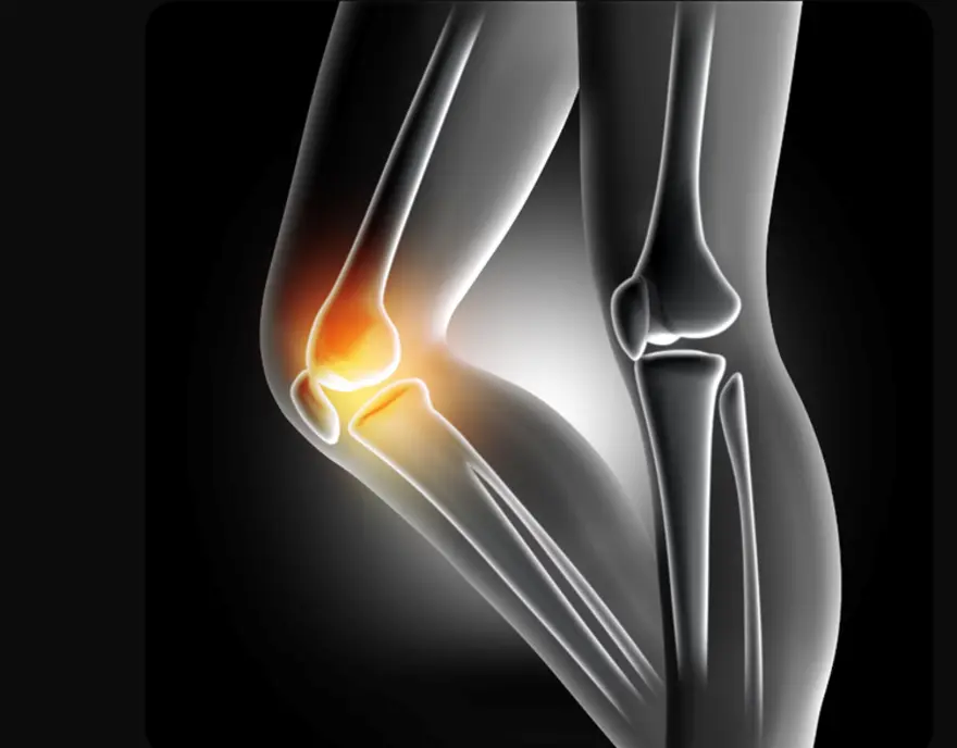 X-ray of osteochondroma showing bone growth and exostosis