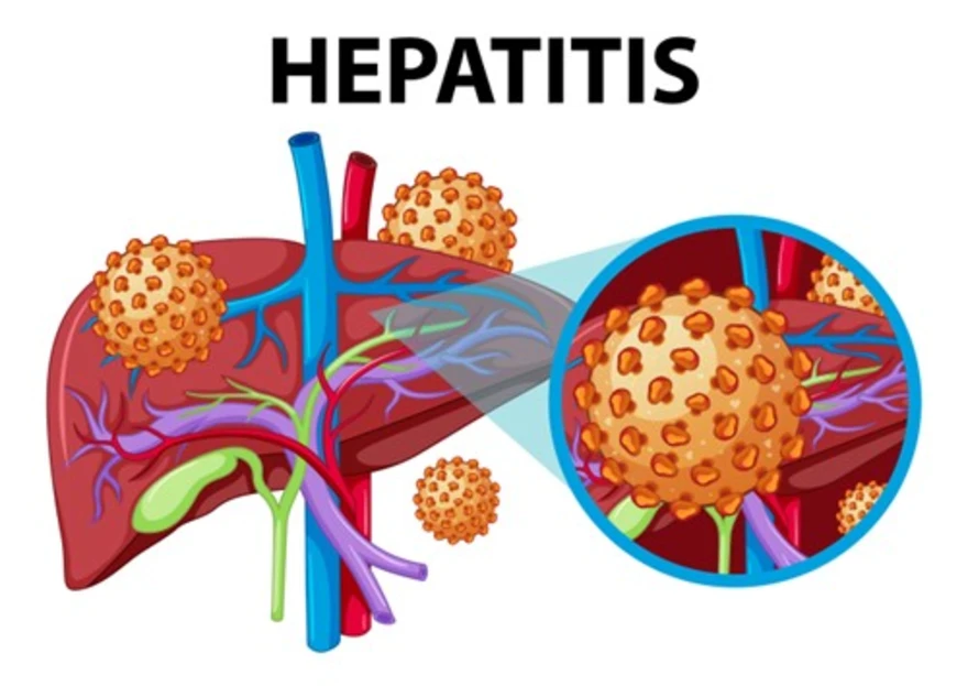 Autoimmune hepatitis