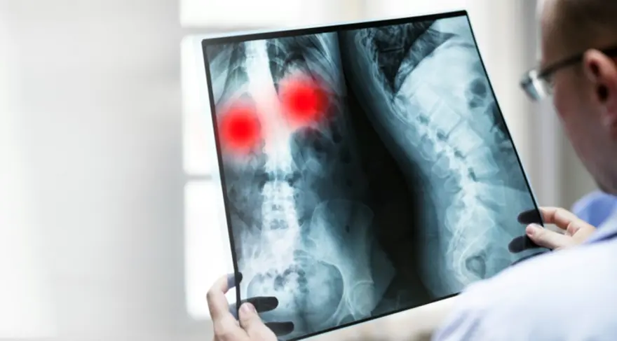 Benign Bone Tumors Diagnosis