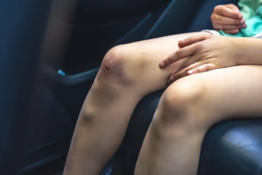 Bone bruise in knee joint