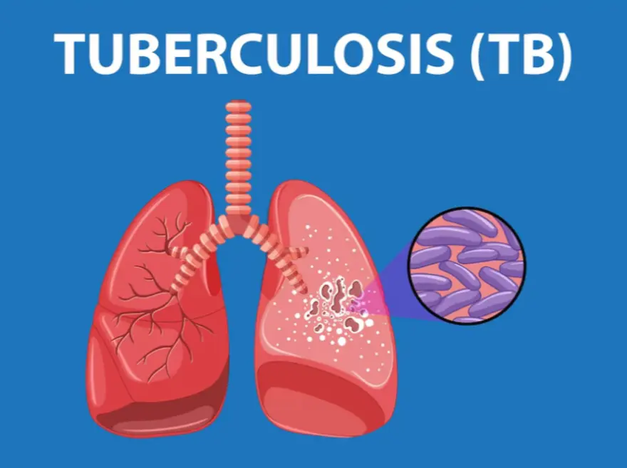 सीबीएनएएटी टेस्ट द्वारा टीबी की जांच