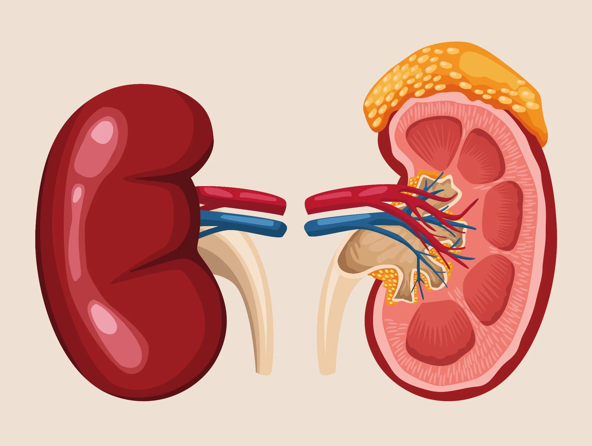 damaged kidneys in end-stage renal disease requiring dialysis or transplant