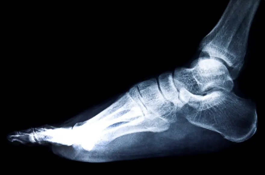 Bone spur in knee joint