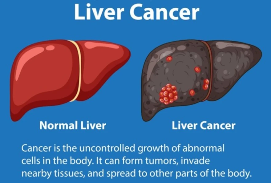 Metastatic Liver Cancer Symptoms and Treatment