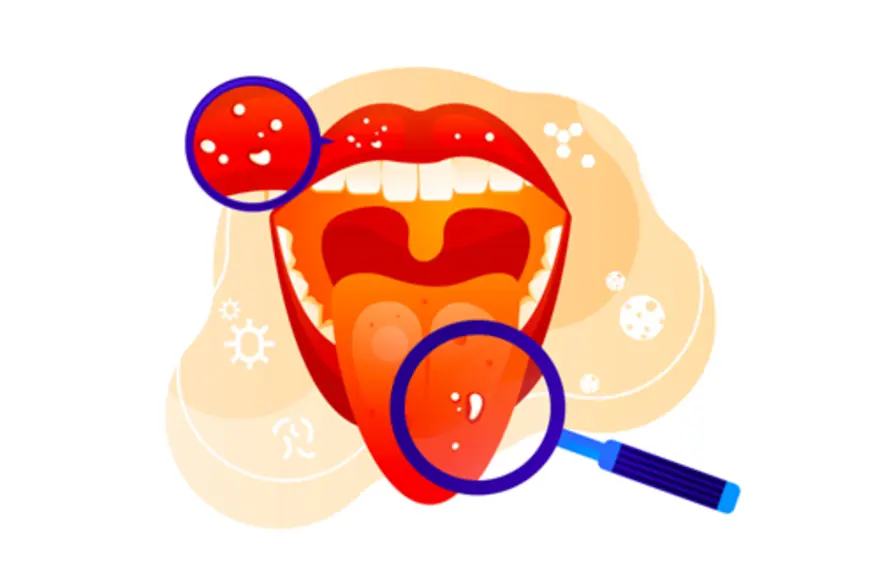 Burning Mouth Syndrome