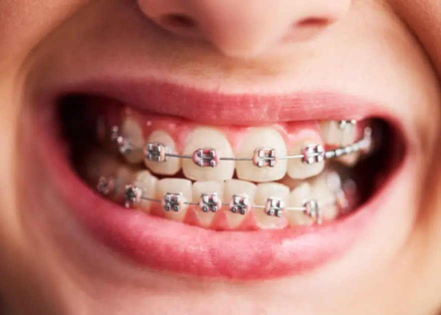 Person wearing dental braces showing braces on teeth